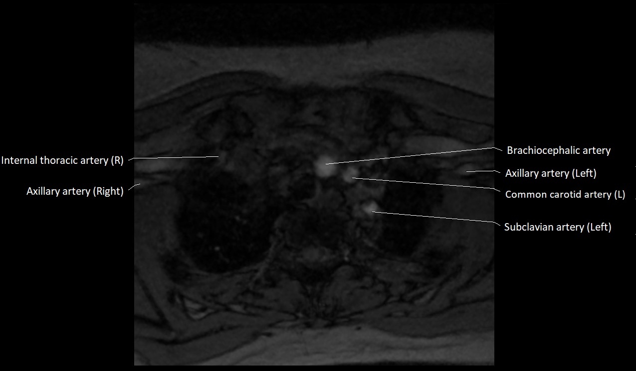 Carotid artery anatomy axial 3T image 75.jpg